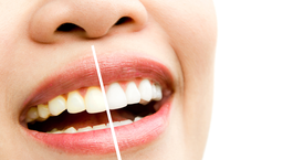 Így legyen ellenálhatatlan a mosolyod!- 8 tipp a fehérebb fogakért